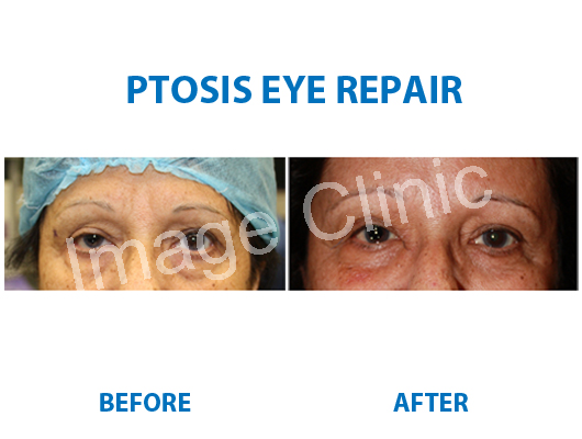 ptosis eye repair